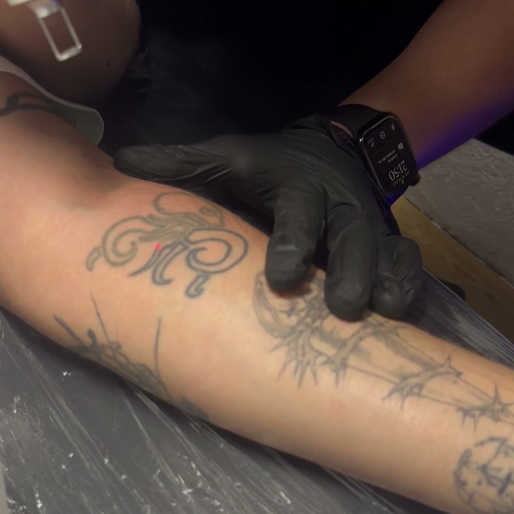 Tatuaje en el antebrazo durante una sesión de remoción con láser