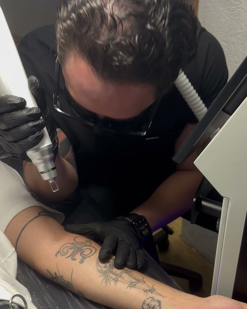 Raymond trabaja con el láser de cerca sobre el tatuaje