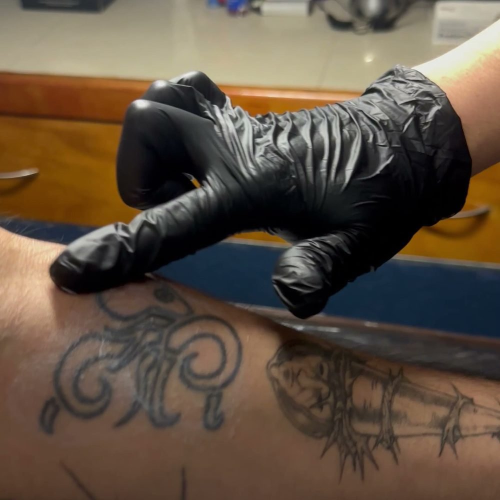 Raymond señala el tatuaje que se va a tratar